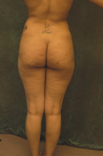 Women's Buttocks Augmentation 518140
