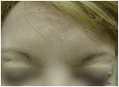 Botox after 267540