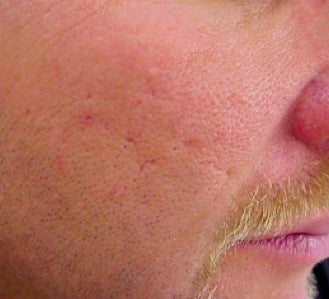 Vbeam treatment for scars before 374583