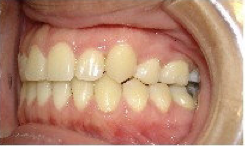 Invisalign Treatment 359152