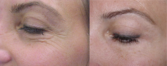 Botox before 423161