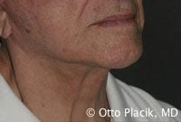 Cervicoplasty 567304