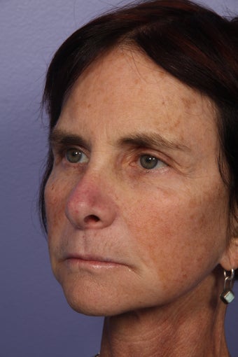 Neck lift after 306411