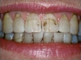 Smile Makeover Treatment before 430545