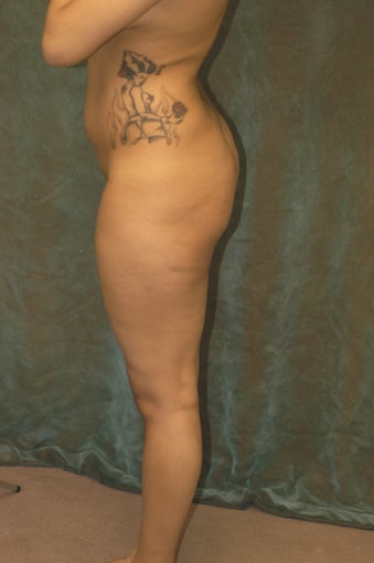Women's Buttocks Augmentation before 518140