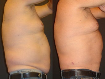 SmartLipo before 96260