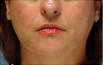 Radiesse injection nasolabial folds and marionette lines after 255551