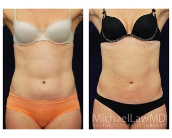 Liposuction before 495040