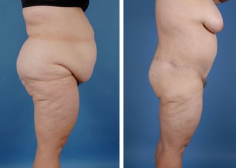 Bilateral Lower Body Lift and Liposuction 303678