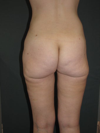 Smart Lipo of Hips, Saddle Bags, and Inner Thighs 325110