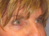 Brow Lift 541474