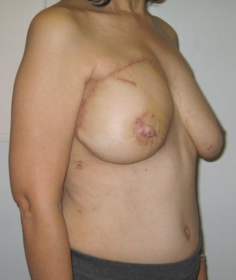 Nipple Reconstruction 523521