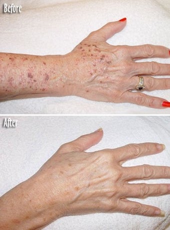 Age spots and sun damage IPL treatment before 6352