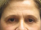 Brow Lift before 541473