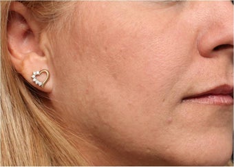 Restylane after 444317
