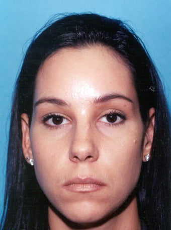 Endoscopic Browlift - Facial Plastic Surgery after 224861