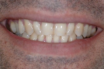 Smile Makeover with Porcelain Crowns before 382125