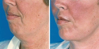 Chin Implant before 642996