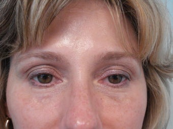 "No-Lift" Eye Lift with Portrait PSR and Filler Injection after 583358