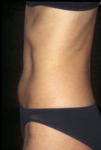 CoolSculpting treatment of unwanted tummy fat after 359376