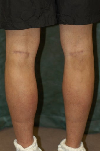Men's Calf Augmentation after 519059