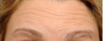Botox before 519026