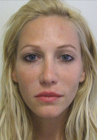 Sculptra 324803