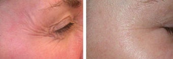 Botox before 69337