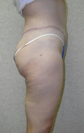 Lower Body Lift 410338
