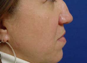 Rhinoplasty 321766