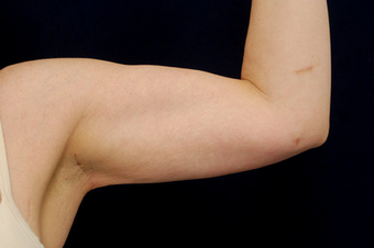 Liposuction - Upper Arms after 393164