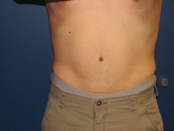 Male Tummy Tuck after 576569