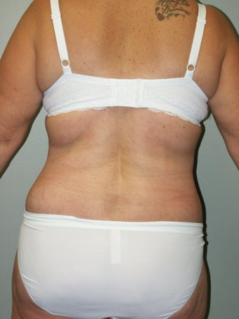 Belt Lipectomy 379797