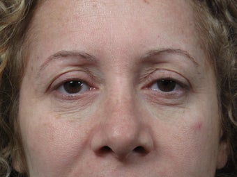 Eyelid Surgery before 306456