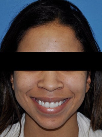 African American Rhinoplasty before 364918