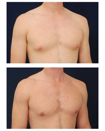 Gynecomastia after 349235