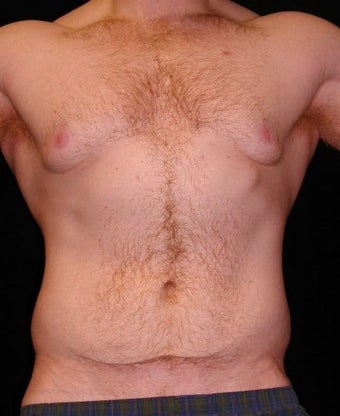 Male Tummy Tuck, Flank Liposuction, Male Breast Reduction before 550017
