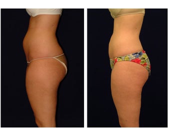 Liposuction before 286710