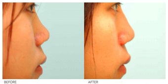 Asian Rhinoplasty before 136818
