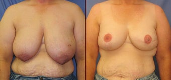 Breast Reconstruction before 73810