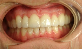 porcelain bridge with veneers replacing teeth 466255
