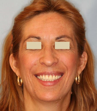Dentures after 109201