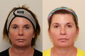 Ultherapy Lower Face after 536671