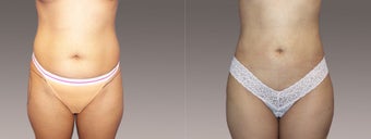 Liposuction before 395827