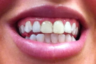 Zoom Whitening after 634706