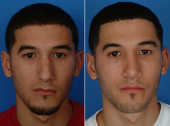 Nose Surgery (Revision Rhinoplasty) before 333096