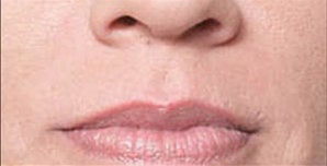 Restylane® after 388346