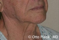 Cervicoplasty 567304