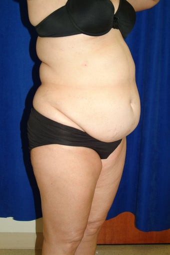 Abdominoplasty with liposculpture of abs, flanks, and waist before 82415