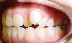 Invisalign Treatment 359152